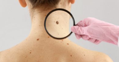 Melanoma