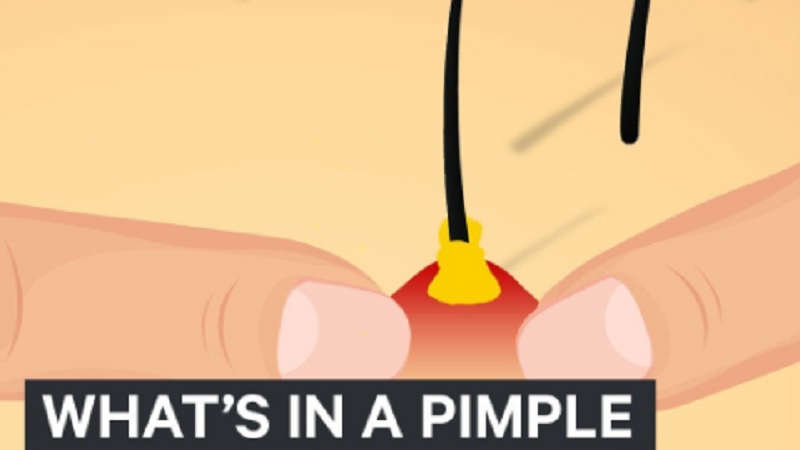 Inside Pimple