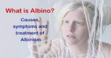 Albinism Symptoms