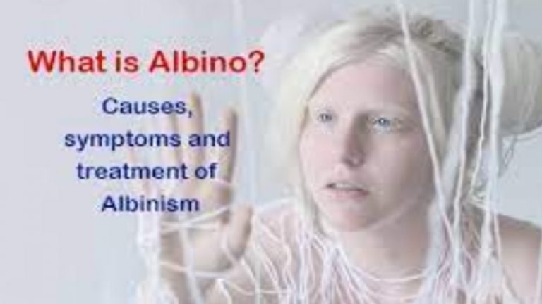 What Is Albinism - Symptoms, Causes, And Diagnosis (VIDEO)