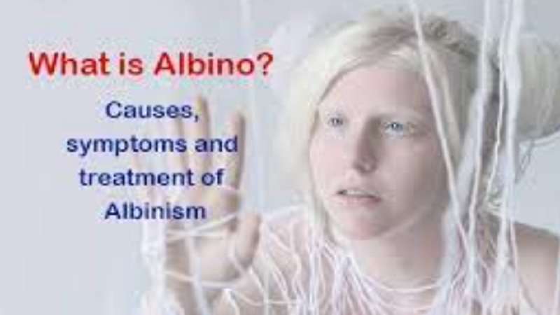 Albinism Symptoms